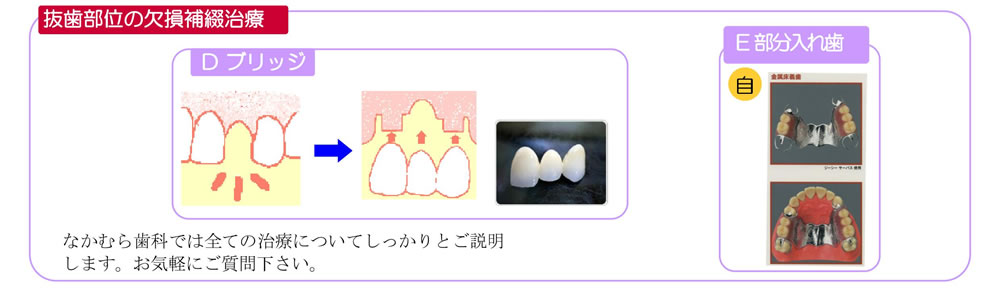 虫歯治療の流れ2