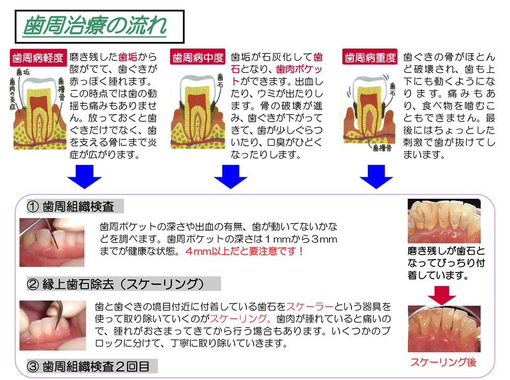 歯周病の流れ1